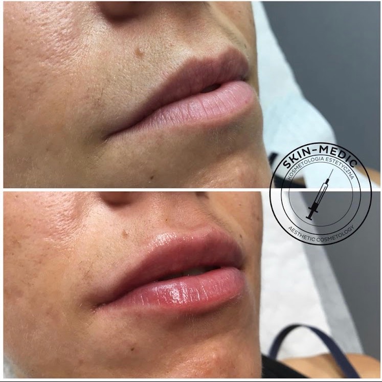 Zbliżenie na usta przed i po zabiegu powiększania, widoczne subtelne zmiany w objętości i nawilżeniu. Logo kliniki w prawym górnym rogu.