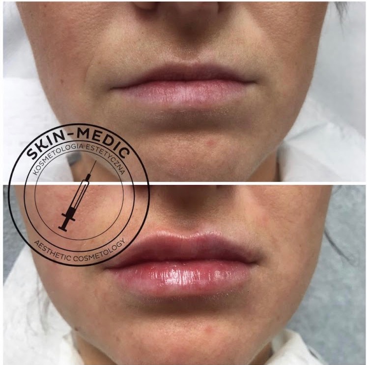 Powiększanie ust kwasem hialuronowym - efekt przed i po zabiegu, widoczny na zbliżeniu ust pacjentki w gabinecie w Poznaniu. Logo firmy w lewym górnym rogu.