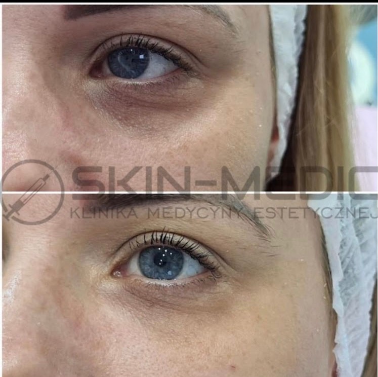 Zbliżenie na okolice oczu kobiety przed i po zabiegu. Widoczne zredukowane cienie pod oczami. Klinika medycyny estetycznej.