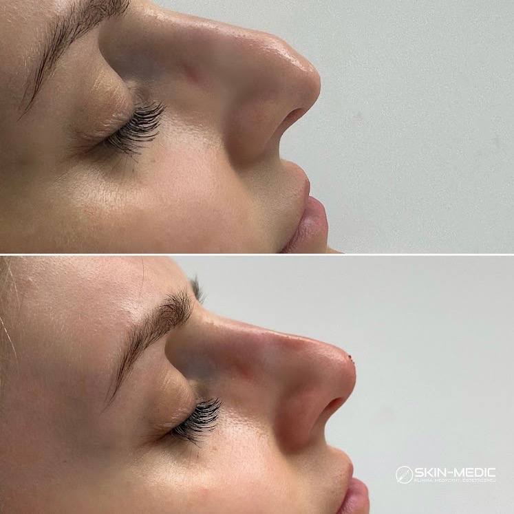 Zbliżenie profilu nosa kobiety, ujęcie przed i po zabiegu korekty, z widocznym logo kliniki medycyny estetycznej w prawym dolnym rogu.