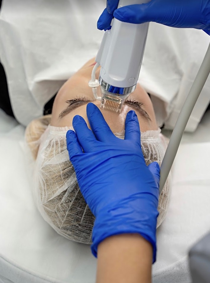 Kobieta poddaje się zabiegowi mezoterapii mikroigłowej na czole w salonie kosmetycznym. Widoczne dłonie w niebieskich rękawiczkach i urządzenie z igłami.