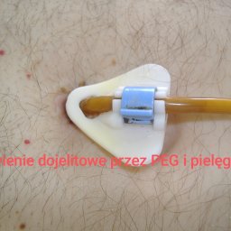 Żywienie dojelitowe PEG i pielęgnacja 