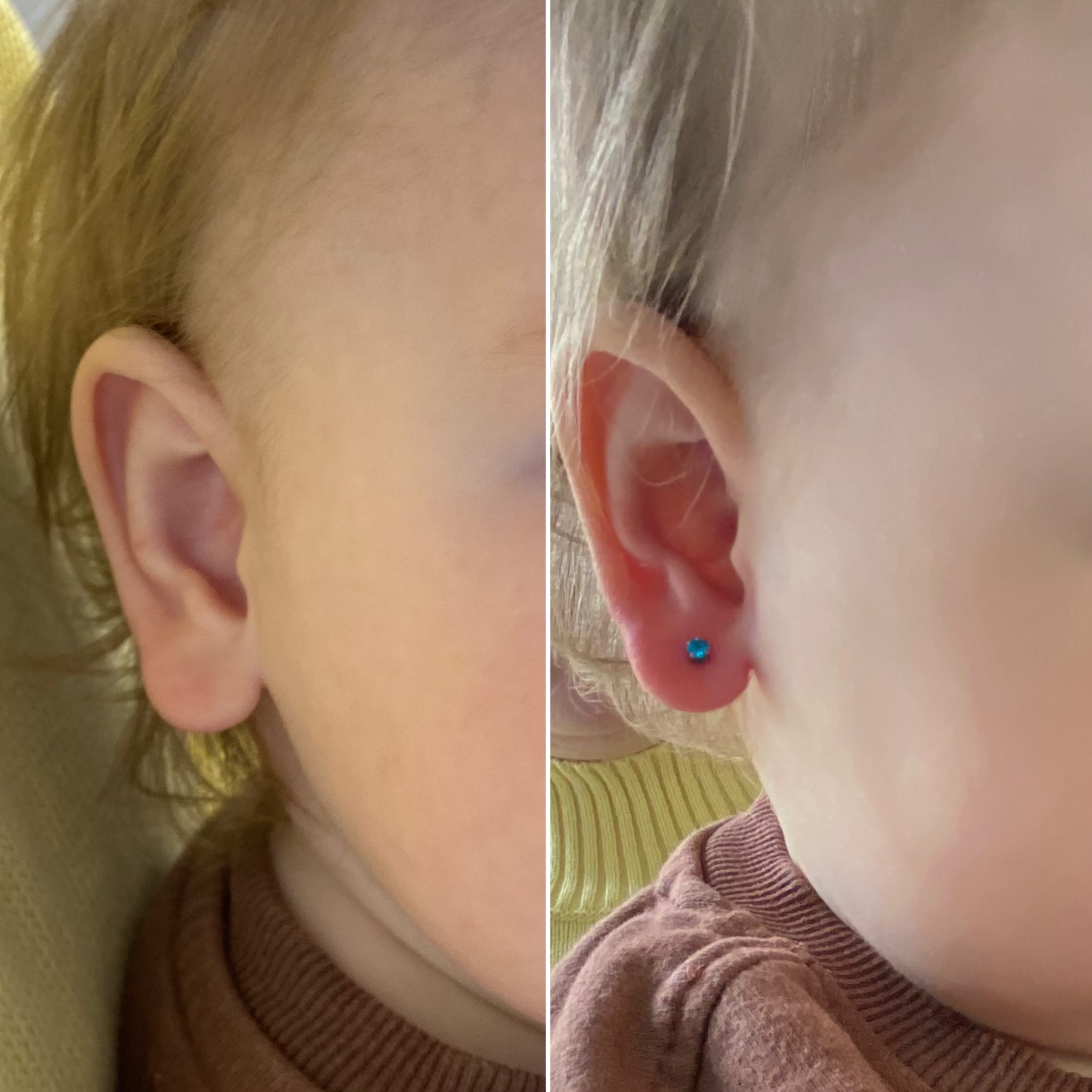Ucho dziecka przed i po przekłuciu z małym, turkusowym kolczykiem. Porównanie zbliżeń, ukazujące efekt zabiegu kosmetycznego.