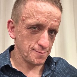 Mr Goldhand Michał Bazylewicz - Portret mężczyzny z licznymi zmianami skórnymi na twarzy i szyi, ubrany w koszulę w drobne kropki, na neutralnym tle.