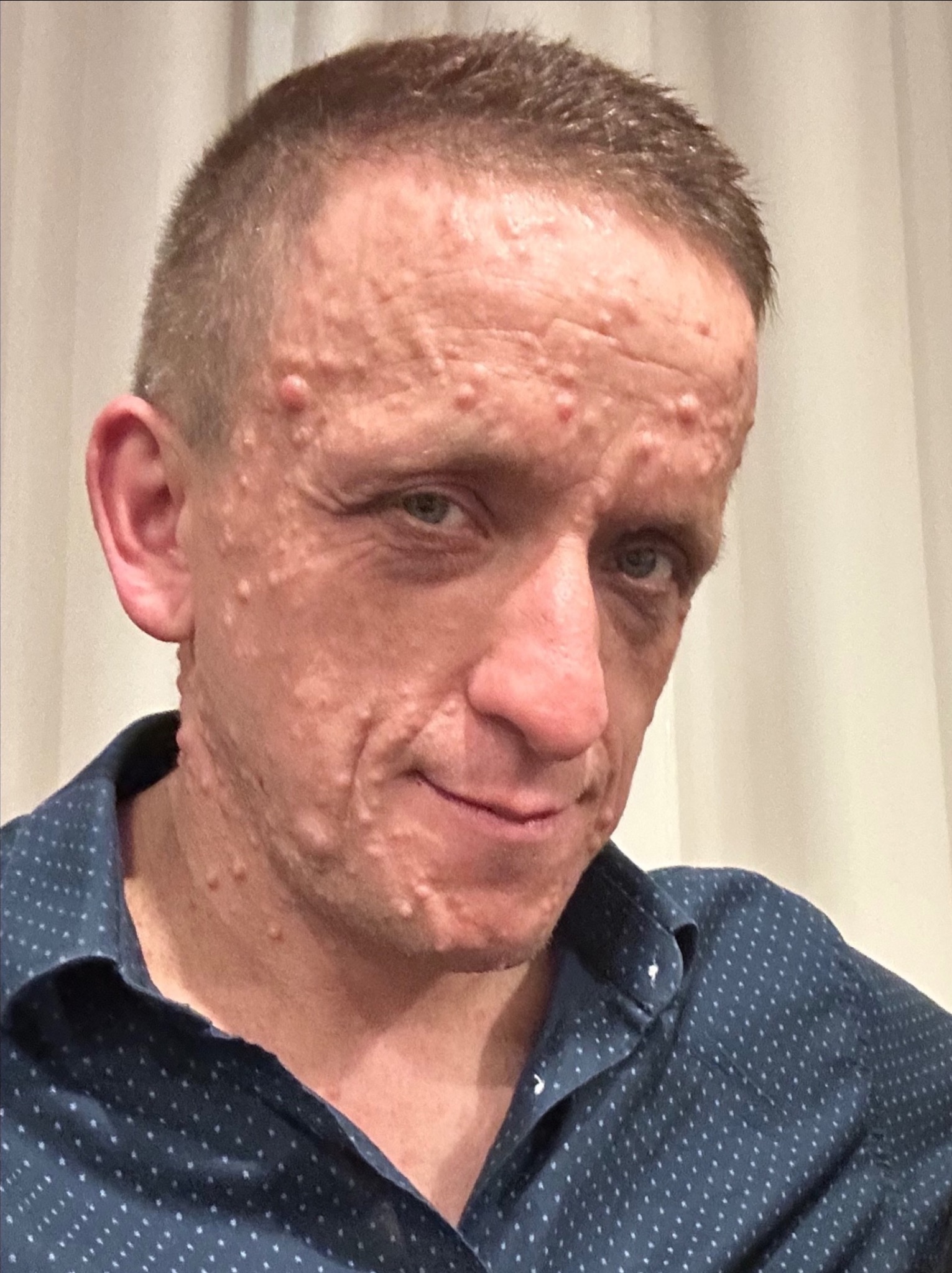 Portret mężczyzny z licznymi zmianami skórnymi na twarzy i szyi, ubrany w koszulę w drobne kropki, na neutralnym tle.