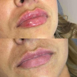 Modelowanie ust - efekt przed i po