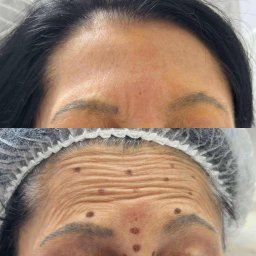 Zastosowanie toksyny botulinowej do zlikwidowania zmarszczek na czole