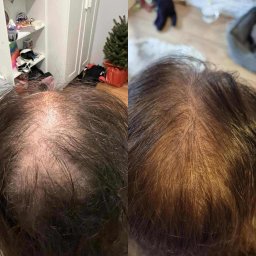 Mezoterapia skóry głowy