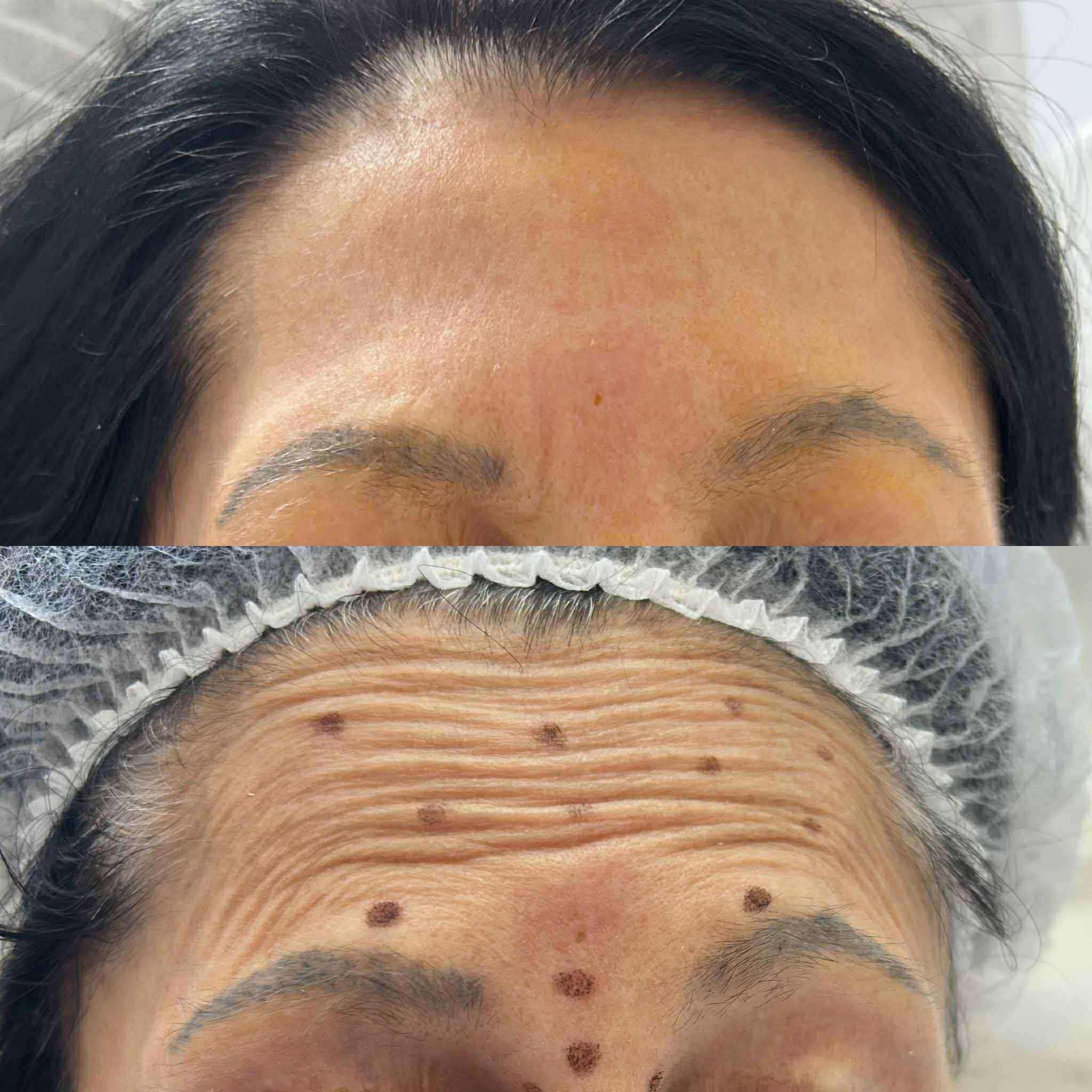 Zastosowanie toksyny botulinowej do zlikwidowania zmarszczek na czole