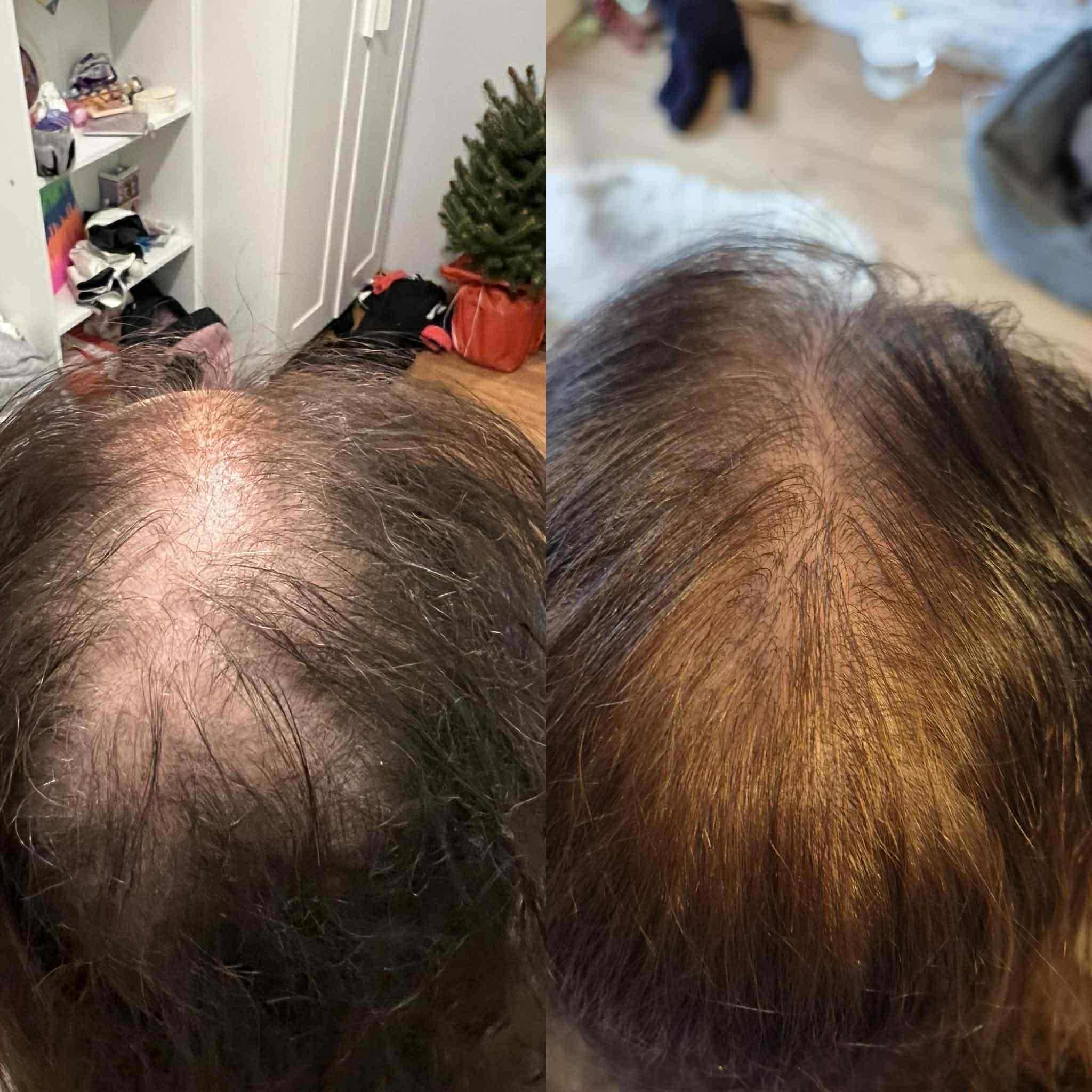 Mezoterapia skóry głowy