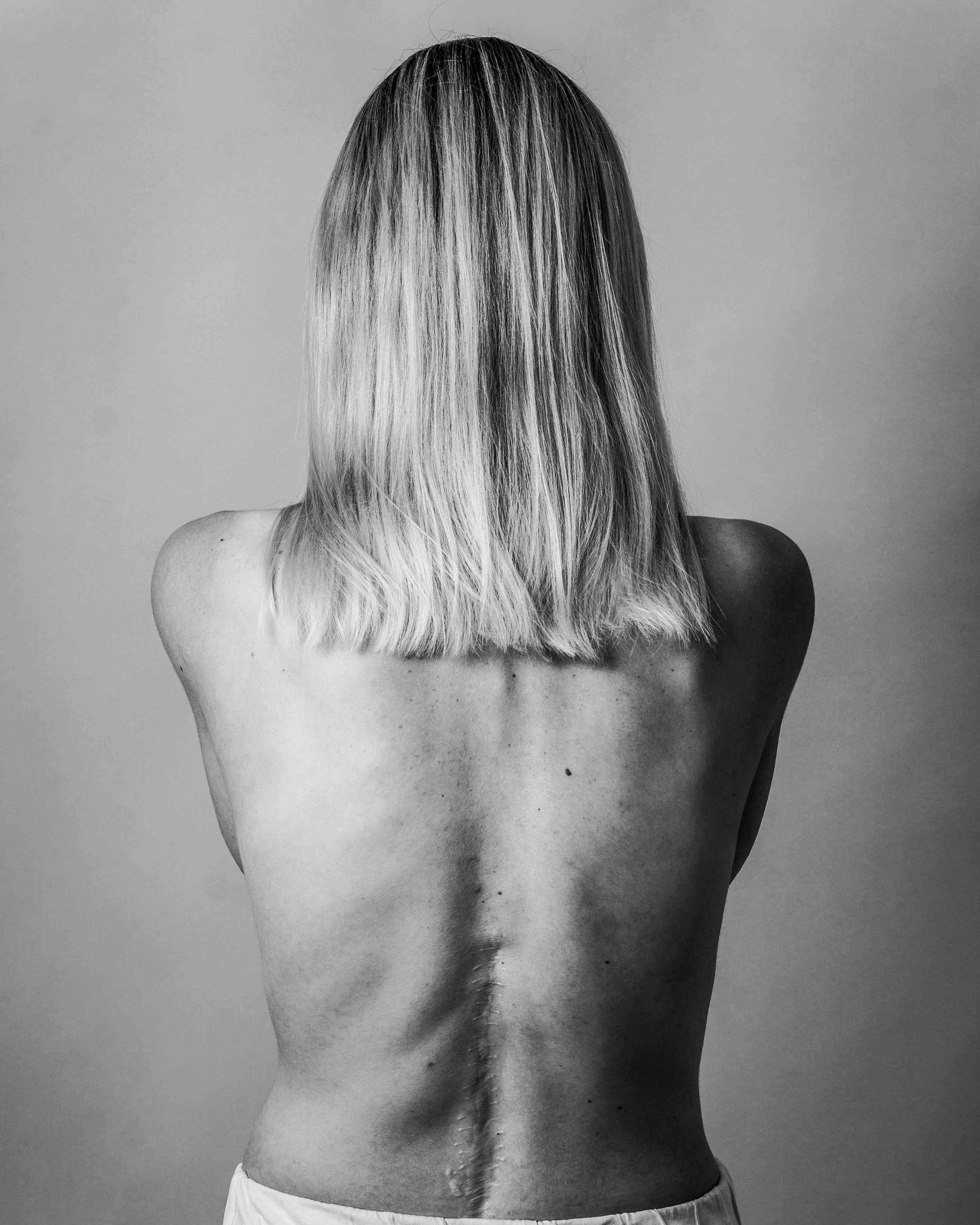 Czarno-białe zdjęcie pleców kobiety z widoczną blizną po operacji kręgosłupa, wykonane w Lublinie. Ujęcie od tyłu, włosy blond do ramion.