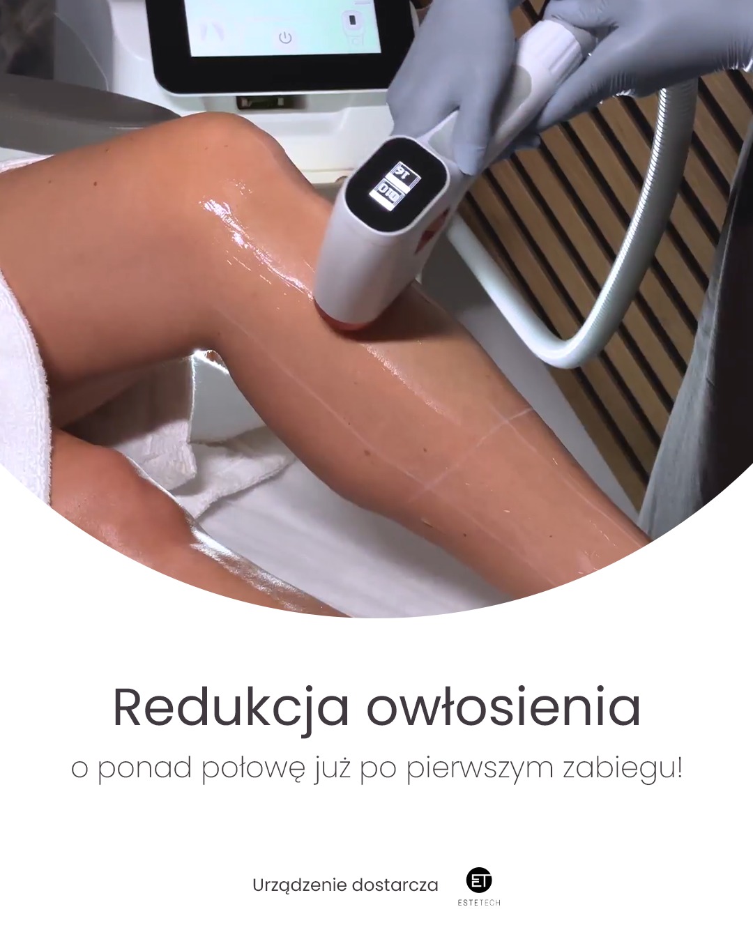 Noga klienta smarowana żelem, poddawana zabiegowi depilacji laserowej. Biały aplikator lasera w dłoni w rękawicy. Widoczny ekran urządzenia.