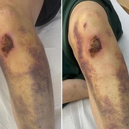 Marta Buchar COSMETOLOGY - Noga z widocznymi siniakami i ranami po zabiegu. Skóra z przebarwieniami i uszkodzeniami. Widoczne ślady po interwencji medycznej lub kosmetycznej.