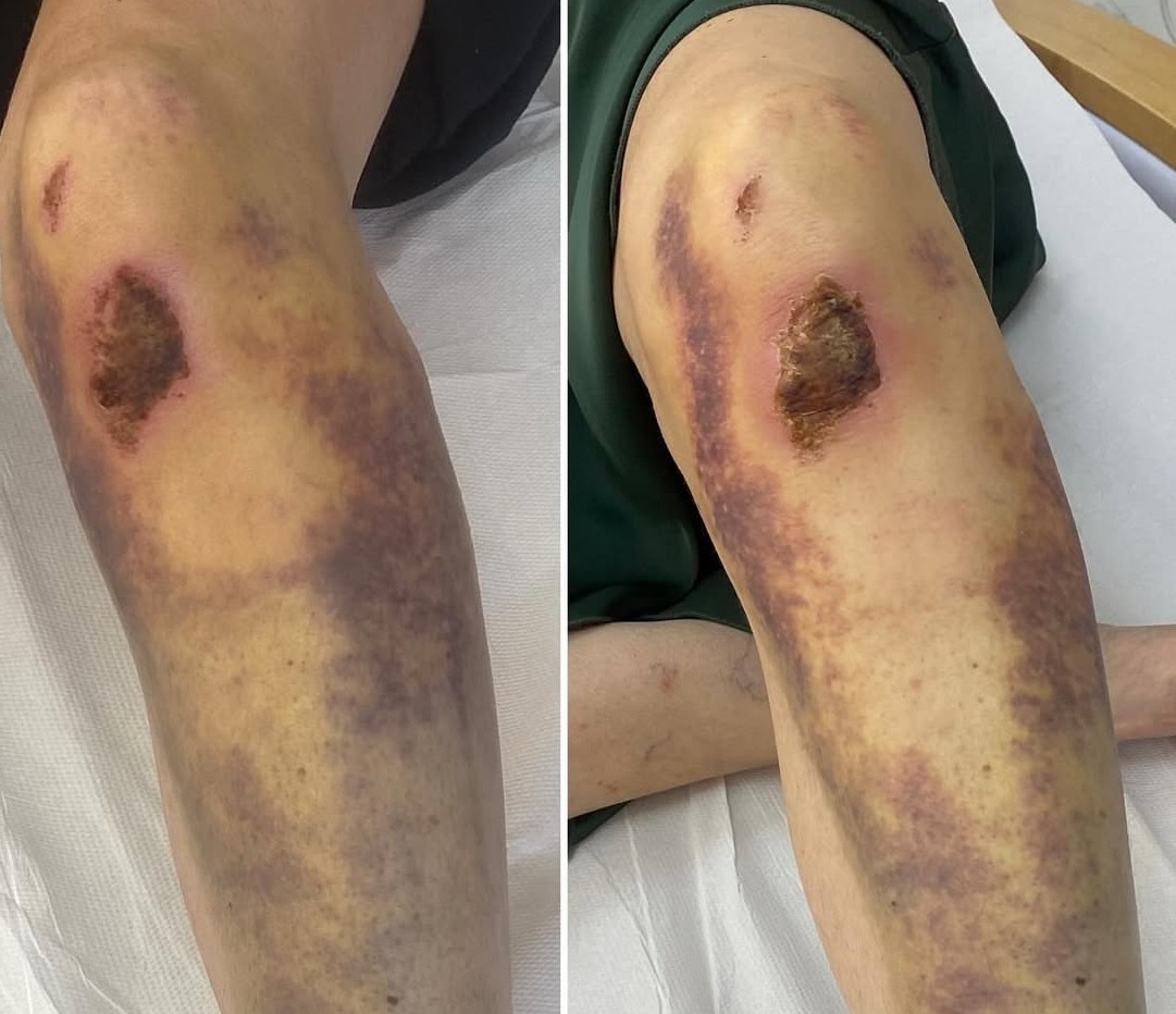 Noga z widocznymi siniakami i ranami po zabiegu. Skóra z przebarwieniami i uszkodzeniami. Widoczne ślady po interwencji medycznej lub kosmetycznej.