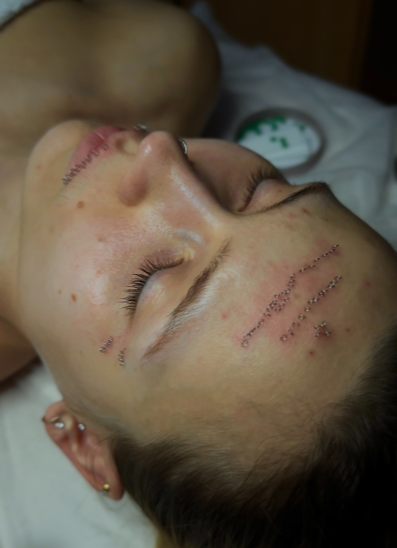 Kobieta po zabiegu kosmetycznym z mikrodermalnymi implantami na czole i wokół ust, leżąca na białym prześcieradle, widok z boku.
