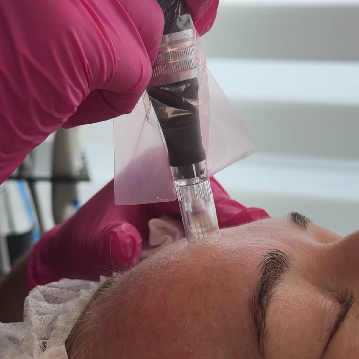 Mikronakłuwanie skóry twarzy wykonywane przez osobę w różowych rękawiczkach. Zabieg upiększający z użyciem specjalistycznego urządzenia.