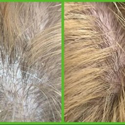 Trychologia Bednarek - Zbliżenie skóry głowy i włosów przed i po zabiegu trychologicznym. Po lewej: widoczny łupież. Po prawej: skóra czysta, włosy w lepszej kondycji. Poprawa stanu skóry głowy.