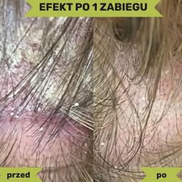 Efekty zabiegu trychologicznego w gabinecie Trychologicznym w Łodzi – przed i po usuwaniu łupieżu. Po terapii skóra głowy jest oczyszczona, złuszczony naskórek usunięty, a włosy odzyskują lekkość i zdrowy blask. Każdy zabieg dobierany jest indywidualnie.