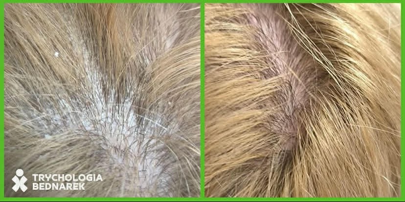 Zbliżenie skóry głowy i włosów przed i po zabiegu trychologicznym. Po lewej: widoczny łupież. Po prawej: skóra czysta, włosy w lepszej kondycji. Poprawa stanu skóry głowy.