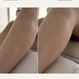 Bloom Skin Sp Z O.O. - Efekt depilacji laserowej – gładka skóra i redukcja włosków.