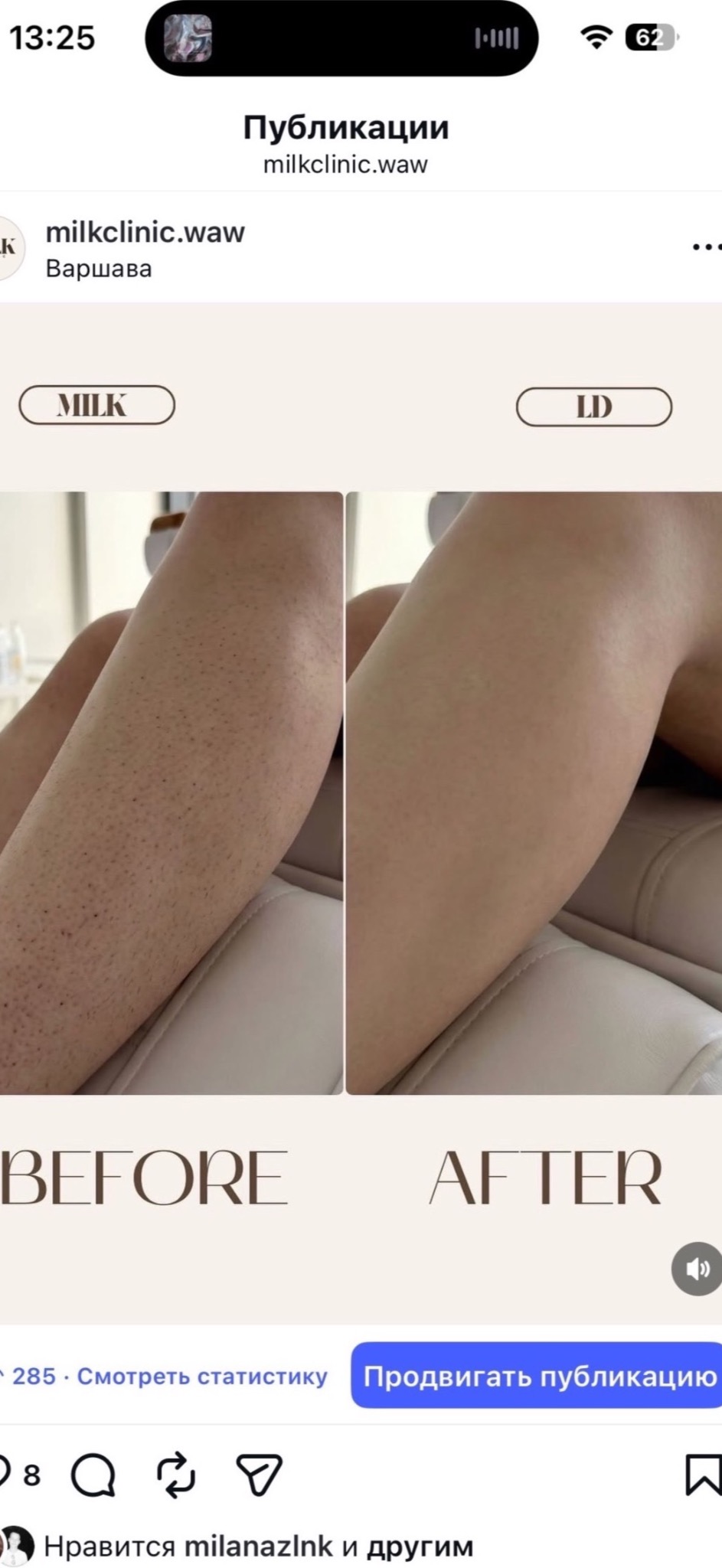 Efekt depilacji laserowej – gładka skóra i redukcja włosków.