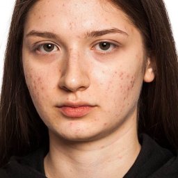 Yuliia Hrushko - Portret młodej kobiety z trądzikiem na jasnym tle, ukazujący problematyczną cerę z bliska, z widocznymi zmianami skórnymi na policzkach i czole.