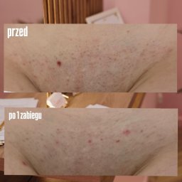Laserrix - Porównanie skóry z widocznym owłosieniem i zaczerwienieniami przed zabiegiem oraz po pierwszej sesji, prezentujące znaczną redukcję włosków.