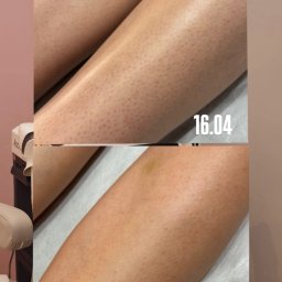 LASERRIX - depilacja laserowa Wrocław - Efekt zabiegu na nogi we Wrocławiu: gładka skóra z minimalną widocznością mieszków włosowych (19.06) w porównaniu do stanu sprzed (16.04), po jednej sesji.