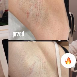 LASERRIX - depilacja laserowa Wrocław - Porównanie pachy przed i po jednym zabiegu, ukazujące redukcję owłosienia i poprawę stanu skóry. Widoczne delikatne zaczerwienienia przed, a po zabiegu skóra jest wyraźnie gładsza.